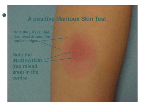 mantoux test positive result images|Mantoux test and its interpretation .